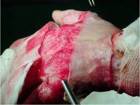 Druhá fáze léčby - vytvoření pokožky transplantací kožního štěpu